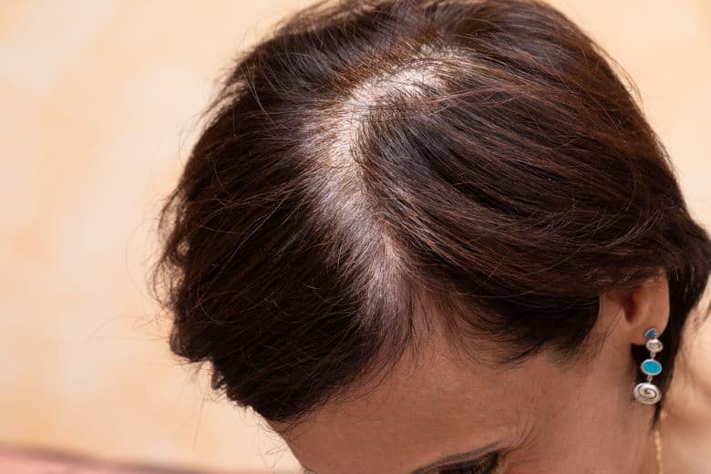 woman with thinning hair at crown